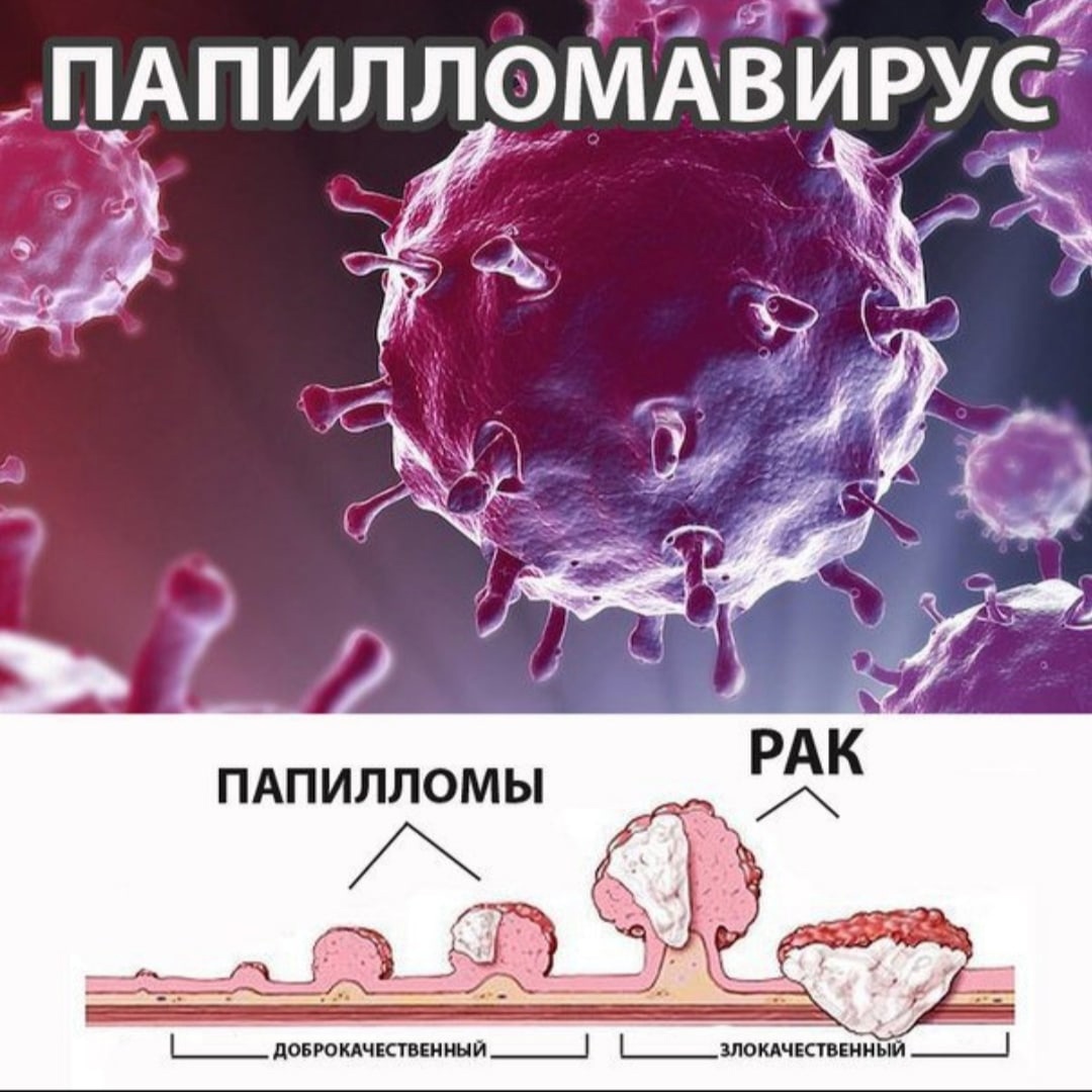 Анализ на вирус папилломы человека (ВПЧ) методом ПЦР и цитологические исследования
